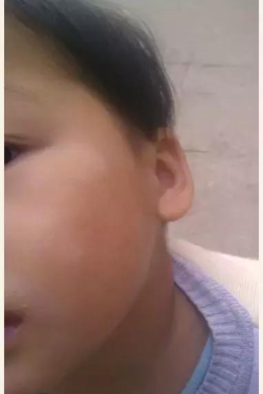 什么原因导致孩子缺锌