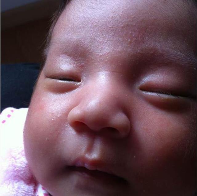 一岁半宝宝脸上长痘痘是怎么回事