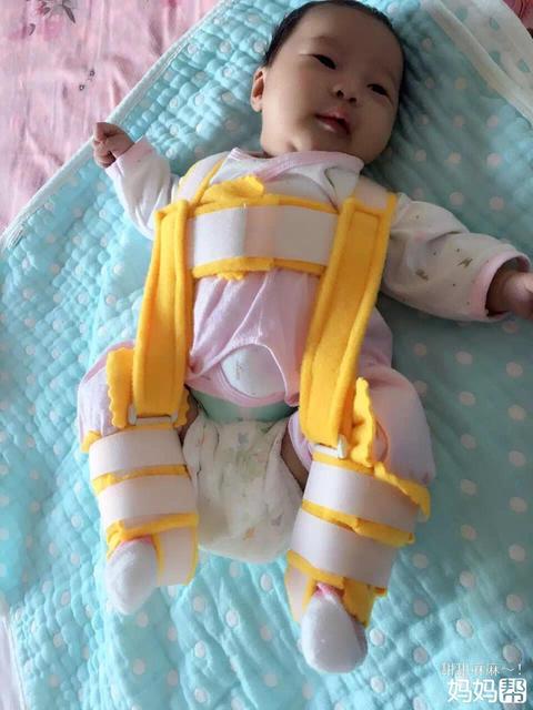 宝宝臀纹不对称是怎么回事