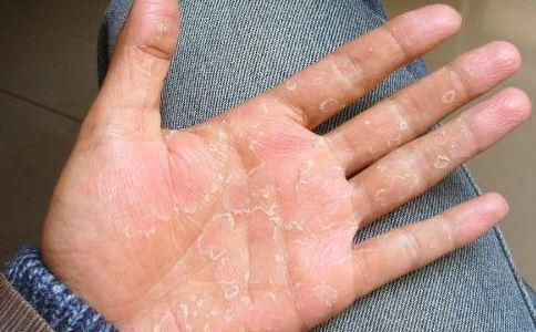 一到夏天手上长水泡是怎么回事