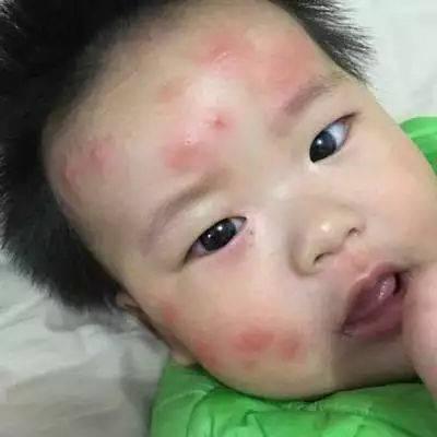 为什么蚊子总是咬宝宝