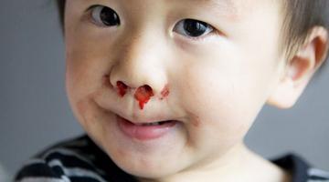孕妇鼻子出血是什么病的征兆