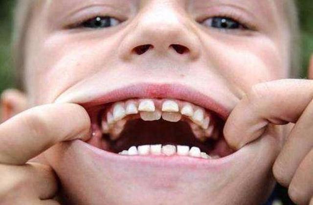 世界上牙齿最多的人图片