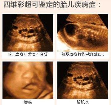 怀孕第几周容易发生胎儿畸形