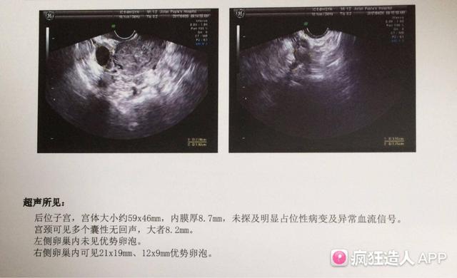 女性出现卵泡萎缩吃什么好呢
