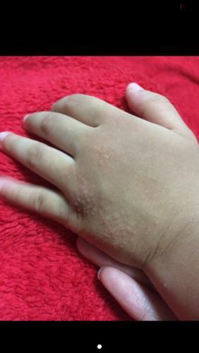 孩子真菌感染用什么药膏