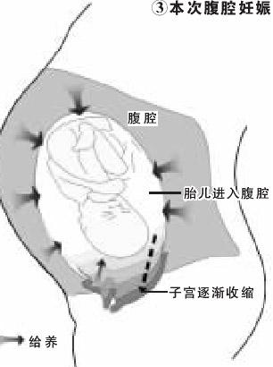 女性宫外孕和男性有关系么