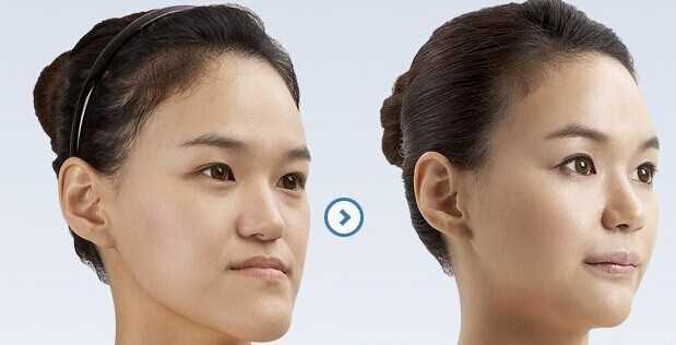 为什么戴牙套3个月了还没有变化