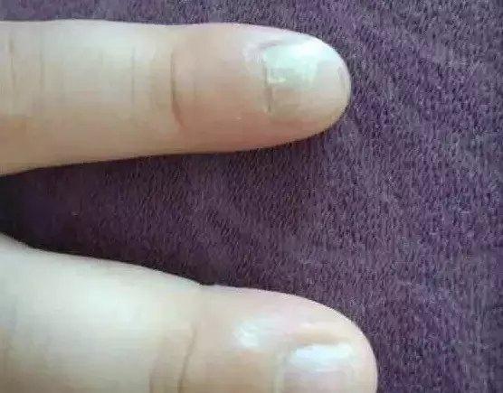 疱疹性咽峡炎和手足口有什么不同