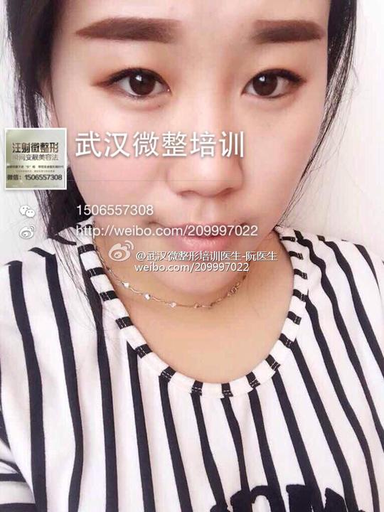 a微整形针剂批发拿货培训肉毒的相册详情微女郎,微博美女创业,微