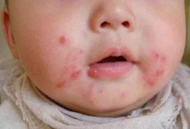 湿疹是不是湿热引起的