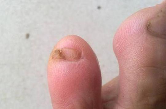 视频:为什么很多中国人的小脚趾分了两瓣，外国人却没有?看完长知识了