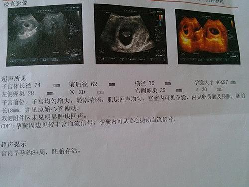 怀孕8个月胎儿b超图