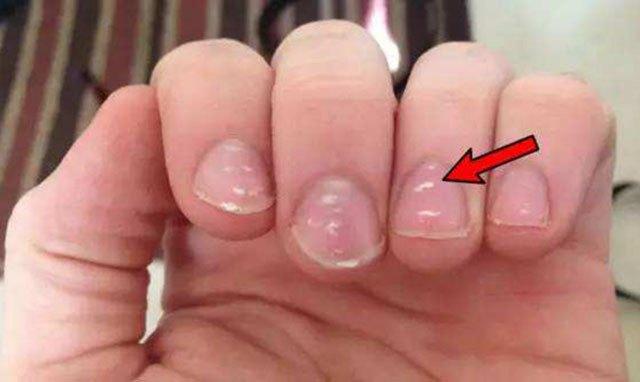 孩子严重缺锌平时有哪些症状