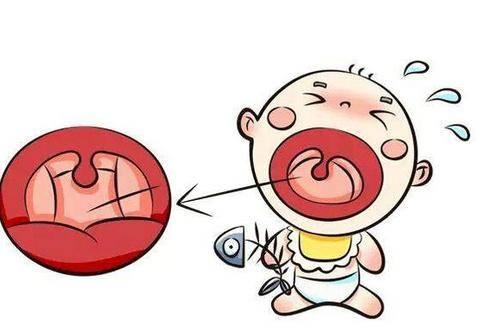 小鱼刺卡喉咙妙招喝可乐