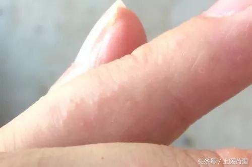 夏天手上爱长水泡是怎么回事
