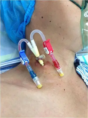 宫腔镜引流管怎么拆 拆引流管疼吗