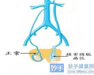 静脉曲张的发病原因与什么有关