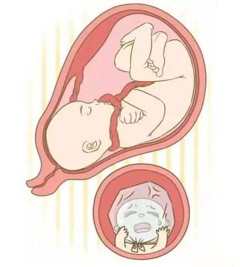 孕期如何避免胎儿脐带绕颈