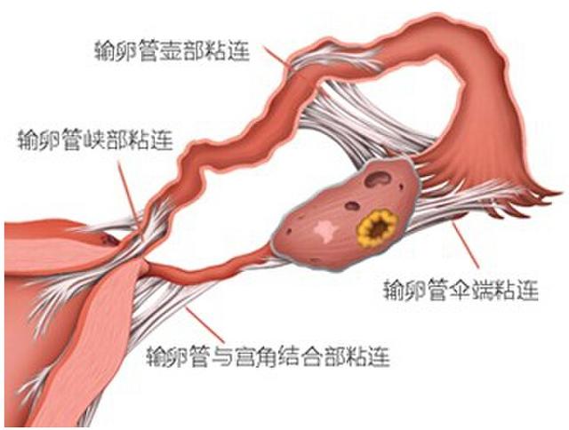 子宫腔粘连的危害有哪些