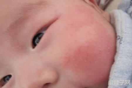 宝宝老爱过敏怎么办