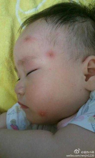 宝宝被蚊子咬了怎么消肿止痒最快