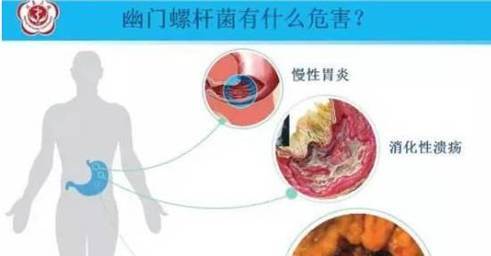 生吃大蒜能杀死幽门螺杆菌吗偏方