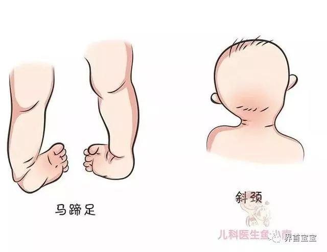 宝宝臀纹不对称是正常的吗