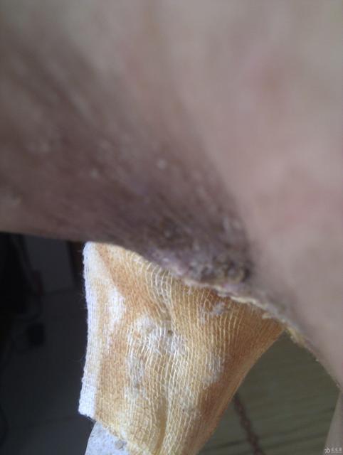 腋臭和狐臭有什么区别怎么辨别图片