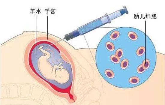 无创和羊水穿刺哪个贵?