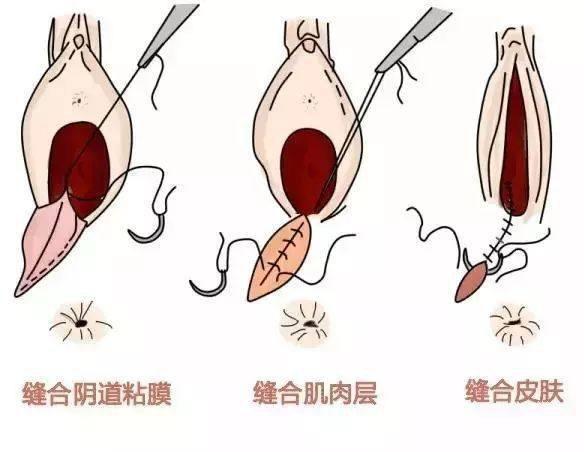 分娩期护理注意事项
