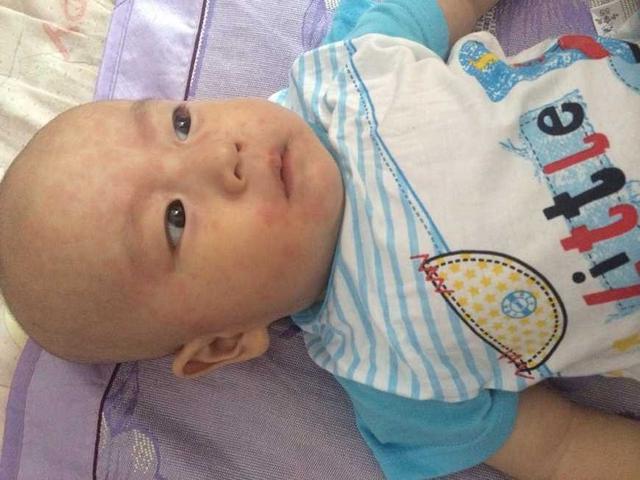 孩子身上总起疹子怎么回事