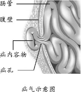 孩子腹股沟疝气会自愈吗