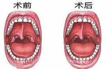 孩子可以切除扁桃体吗