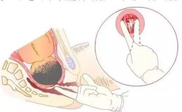 宫口开十指是十个手指头吗