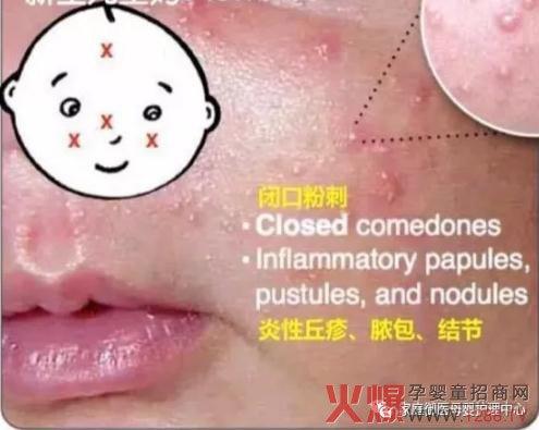 孕妇胎毒的症状有哪些