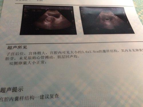 选择B超监测排卵期