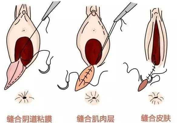 侧切后会阴伤口疼怎么办