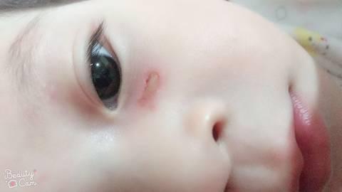 宝宝烫伤怎么办处理