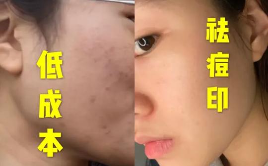 学生党如何低成本去红黑痘印?教你逆袭水煮蛋肌!