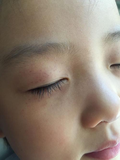 孩子三岁多女孩今天发现眼睛周围长了好多小红点左右眼都是请问咋