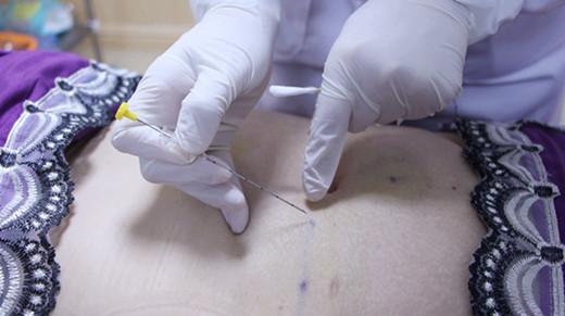 产后可以做埋线减肥吗