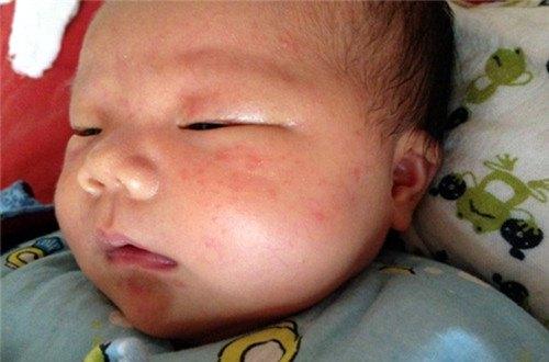婴儿的痱子和湿疹有什么区别
