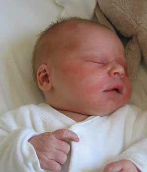 如何区分痱子和湿疹?