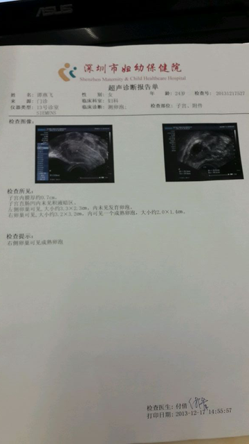 做b超监测卵泡多少钱