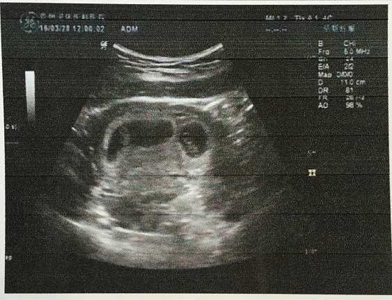怀孕几周有胎心胎芽