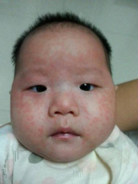 如何区别麻疹和幼儿急疹