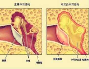 儿童早期中耳炎症状表现有哪些
