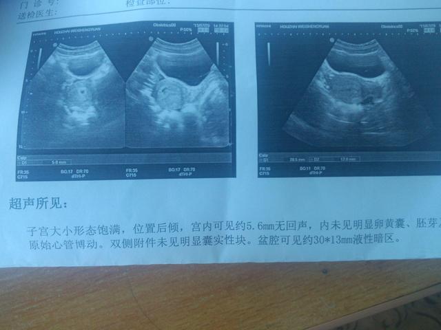 孕期做B超对胎儿有影响吗