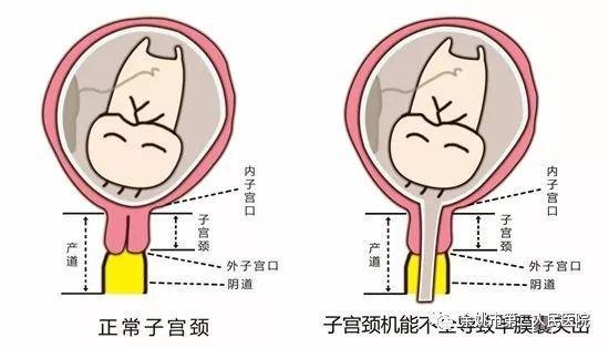 先天性宫颈机能不全的原因